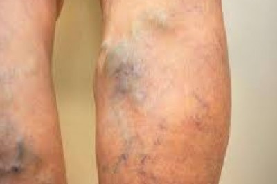 6 Reasons Why Laser Varicose Veins Is The Best?