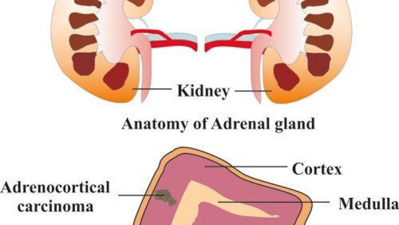 By 2027, the global market size for Adrenocortical Carcinoma Treatment is expected to reach USD 604.5 million, from USD 529.2 million in 2020, with a CAGR of 1.5% during forecast period 2021-2027