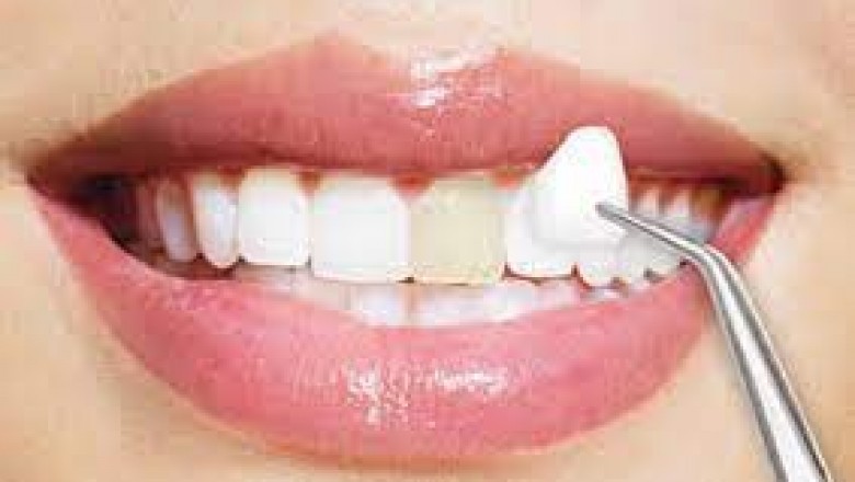Dental Veneers: Disadvantages And Advantages