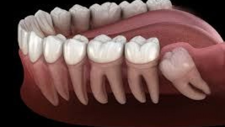 Periodontitis: What Are The Different Stages?