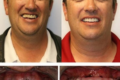 beylikdüzü implant