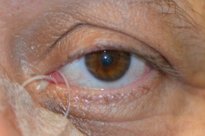 Nasal Lacrimal Stents are stents that are inserted into the lacrimal system of the nose to keep it open.