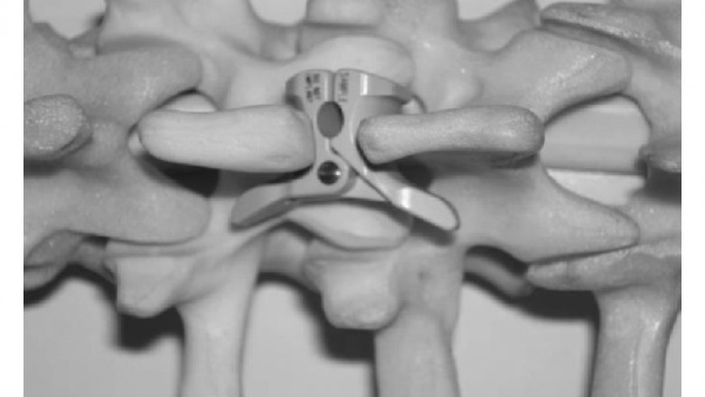 Seven Latest Developments In Interspinous Process Decompression Devices.