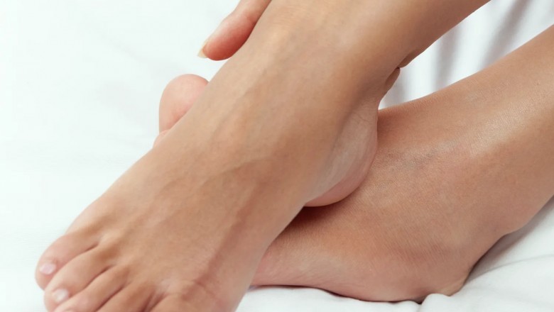 What are the Misconceptions in Varicose Vein Disease?