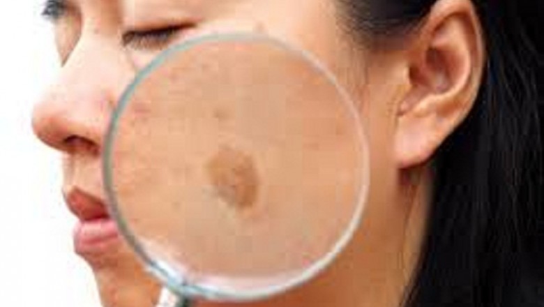 Melasma Treatment Market Size, Share, Development (2019-2026) Covid19 Impact