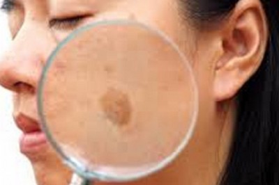 Melasma Treatment Market Size, Share, Development (2019-2026) Covid19 Impact
