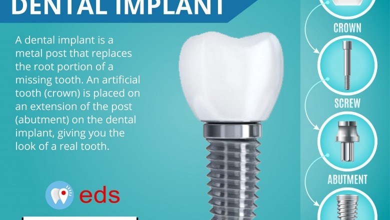 Structure of Dental Implant | Best Emergency Dentist 24/7