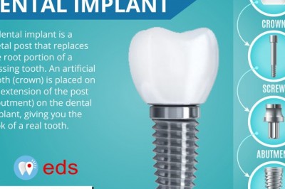 Structure of Dental Implant | Best Emergency Dentist 24/7