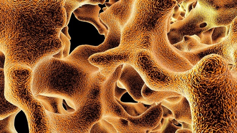 Osteoporose en erectiestoornissen bij mannen