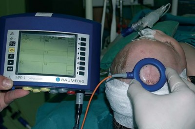 The market for intracranial pressure monitoring devices is expected to grow over the next decade as neurodegenerative disorders and traumatic brain injuries become more common.