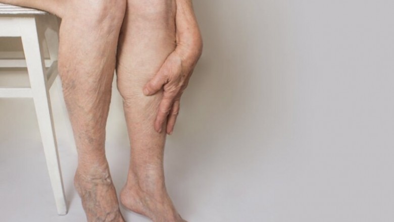 Houston Spider Vein Treatment Near Me.