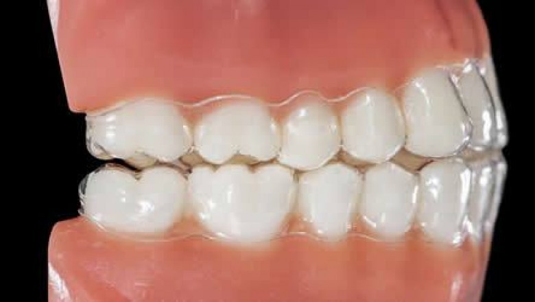Is Fluoride Treatment Necessary For You?