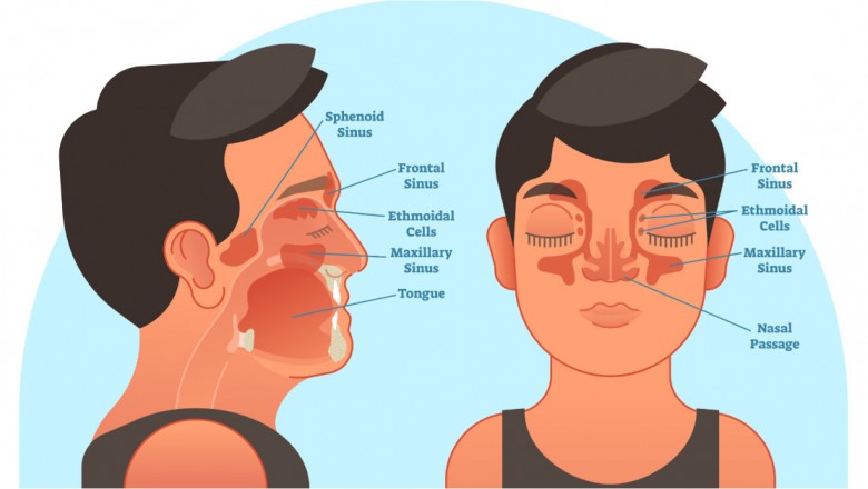 What Happens If Nasal Polyps Go Untreated?