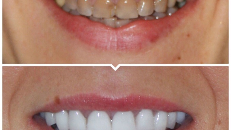 Dental Veneers