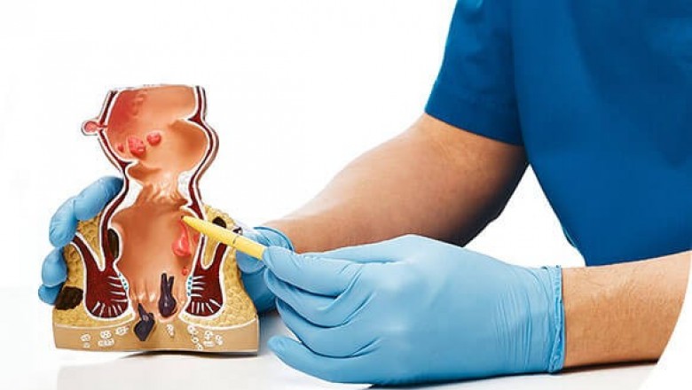 Piles Doctor Bangalore
