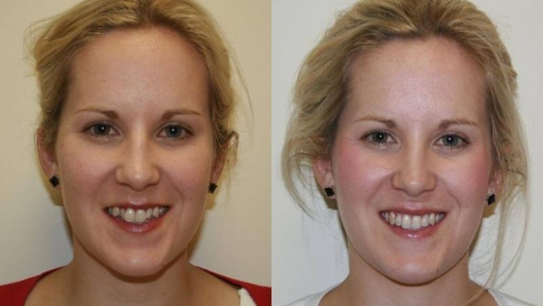 Know-How Long Do Porcelain Veneers Last