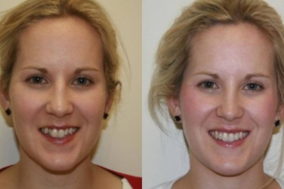 Know-How Long Do Porcelain Veneers Last