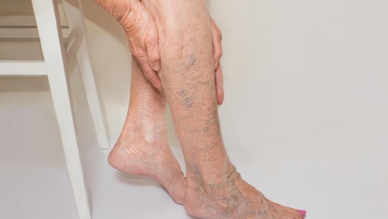Try these 5 tips to keep vein problems away!