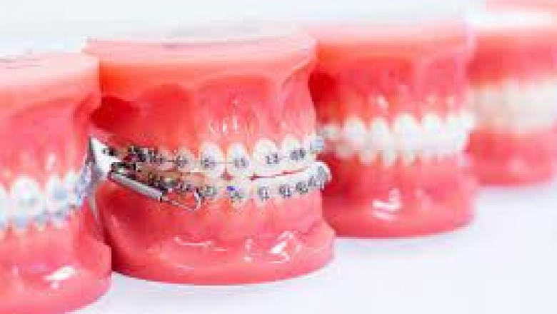 How to Choose the Right Veneers Specialist?