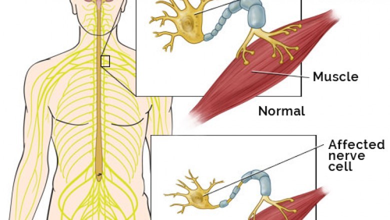 Amyotrophic Lateral Sclerosis Market Covid-19 Analysis Insights by Size, Growth, Trends, Share, Competitive Analysis By Emerging Technology and Advancement 2027 | Mitsubishi Tanabe Pharma America (USA), Ionis Pharmaceutical (