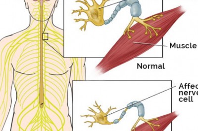 Amyotrophic Lateral Sclerosis Market Covid-19 Analysis Insights by Size, Growth, Trends, Share, Competitive Analysis By Emerging Technology and Advancement 2027 | Mitsubishi Tanabe Pharma America (USA), Ionis Pharmaceutical (