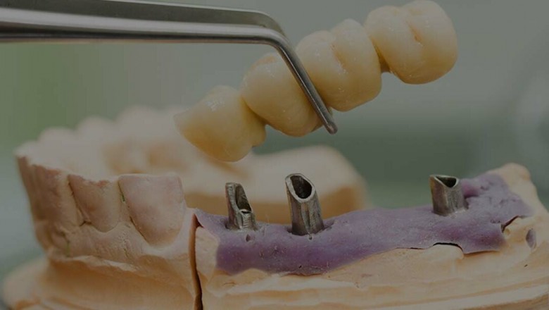 What is the advantage of having a dental implant?