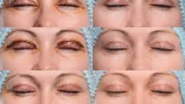 What is the Difference Between an Eyelid Surgery and a Brow Lift?