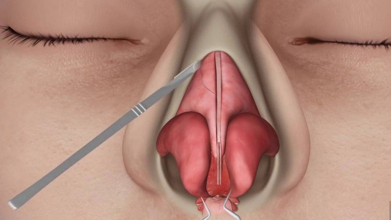 nose surgeon delhi