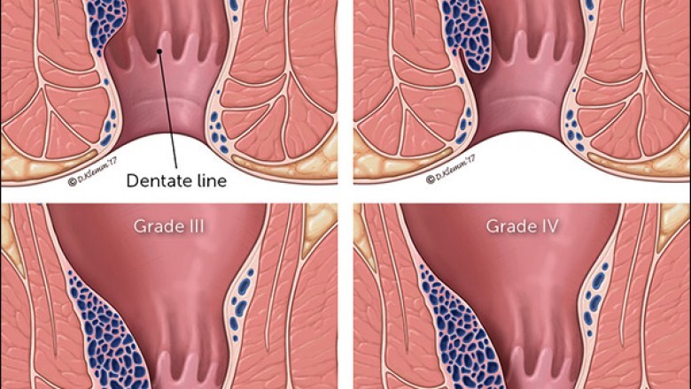 Hemorrhoid Treatment Devices Market Trends, Size, Share, Demand, Industry Analysis, Key Player profile, Regional Outlook and Comprehensive Research Analysis by 2027