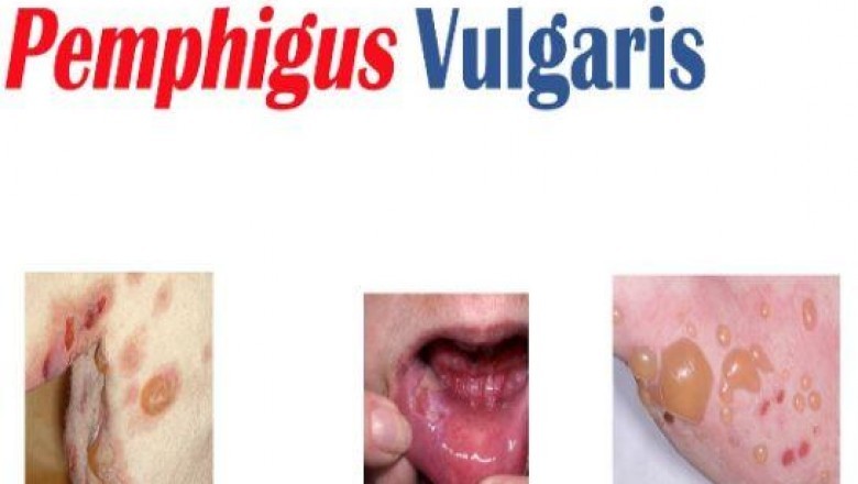 A treatment for pemphigus vulgaris is the prevention of blister formation as well as healing blisters