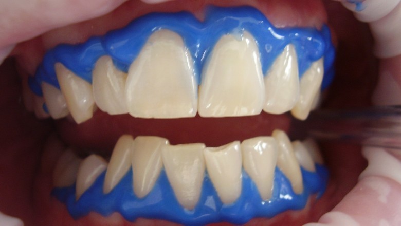 Emergency Walk In Dentist in Houston