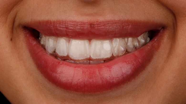 Average Cost of Dental Implants