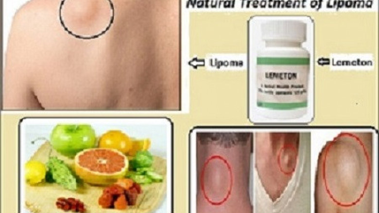 Lemeton Herbal Supplement for Natural Treatment of Lipoma