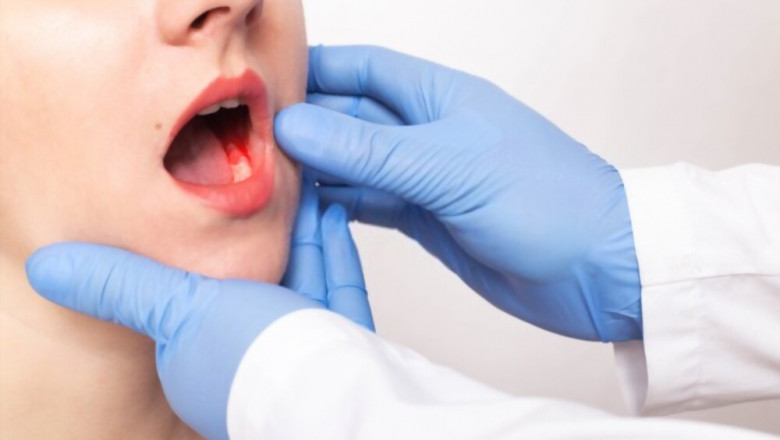 Mouth Sore Treatment - Top 2 Mouth Sore Treatments