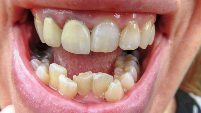 Why Wisdom Teeth Removal? Here are 3 Reasons!