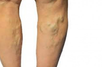 How Intense Pulsed Light Therapy Helps In Treating Veins?
