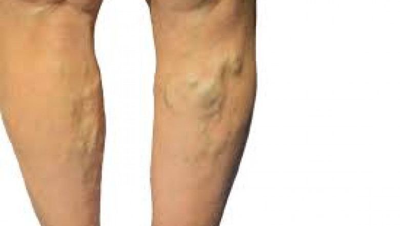 How You Can Prevent Spider Veins?