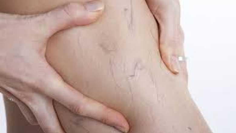 Importance Things To Consider for Spider And Varicose Vein Removal!