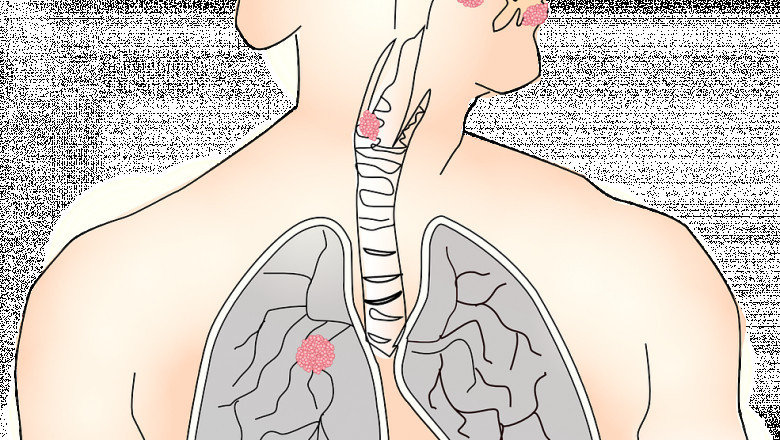 What are the symptoms and signs of lung cancer?