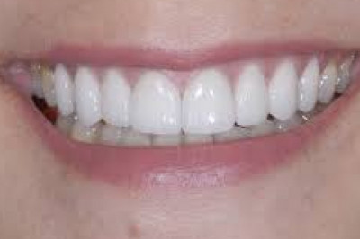 Tooth Replacement Vienna Va