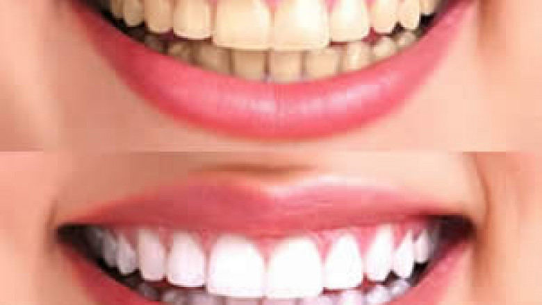 Cosmetic Dental Bonding: How To Get A Radiant Smile?