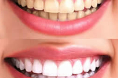 Cosmetic Dental Bonding: How To Get A Radiant Smile?