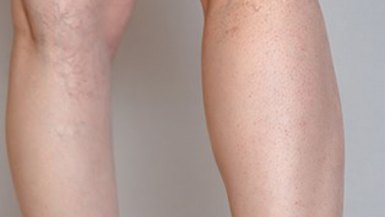 How to Remove Spider Veins With Laser Treatments?