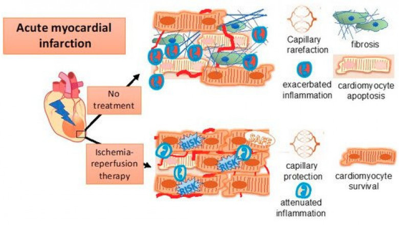 Ischemia Reperfusion Injury Therapeutics Market Sales Forecasts Reveal Positive Growth Through 2027