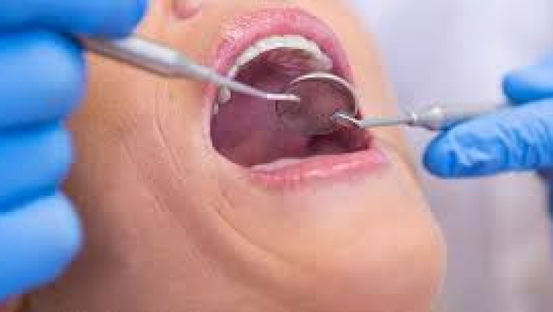 Dental Implants in Houston Tx