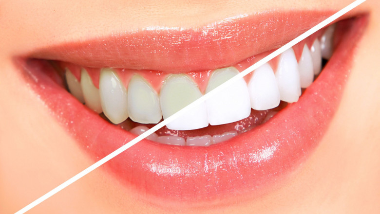 Global Tooth Whitening Market Report 2019 - Market Size, Share, Price, Trend and Forecast