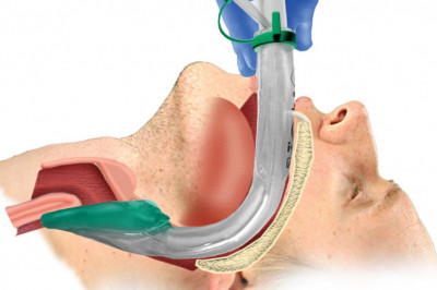 Airway Management Market Demand, Industry Analysis, Key Player profile, Regional Outlook and Comprehensive Research Analysis by 2027