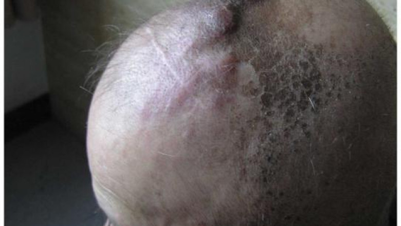 Angiosarcoma Treatments Are Administered To Patients, Who Are Going Through This Condition, Which Is a Very Rare Type of Cancer