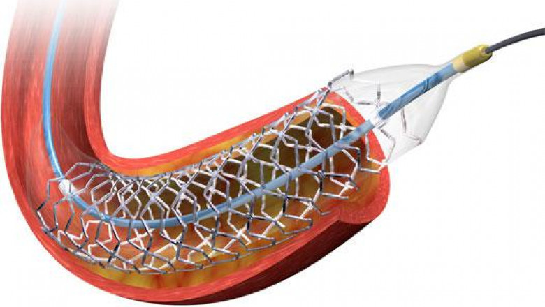 Cardiovascular Stents are the cylindrical-shaped equipment which help in maintaining the function of arteries during heart treatments