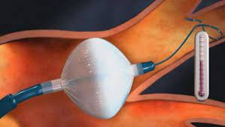 Cryoablation Devices Market Research Report, Size, Share and Forecast